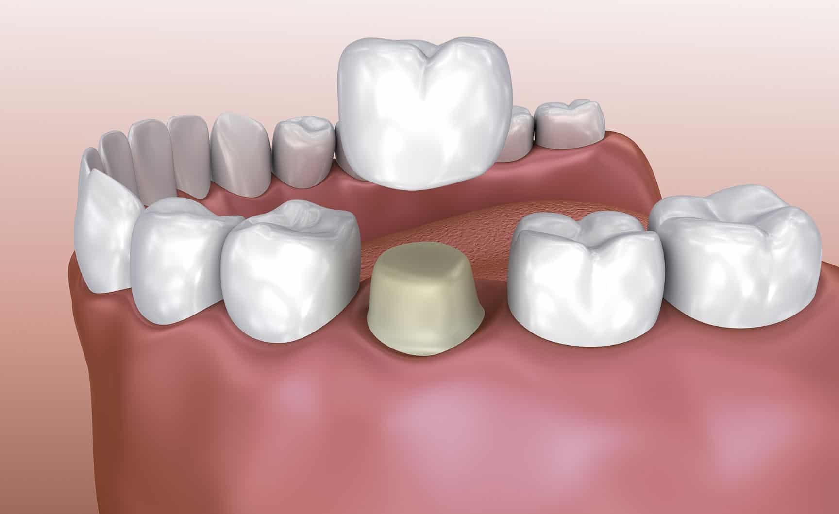 dental crown