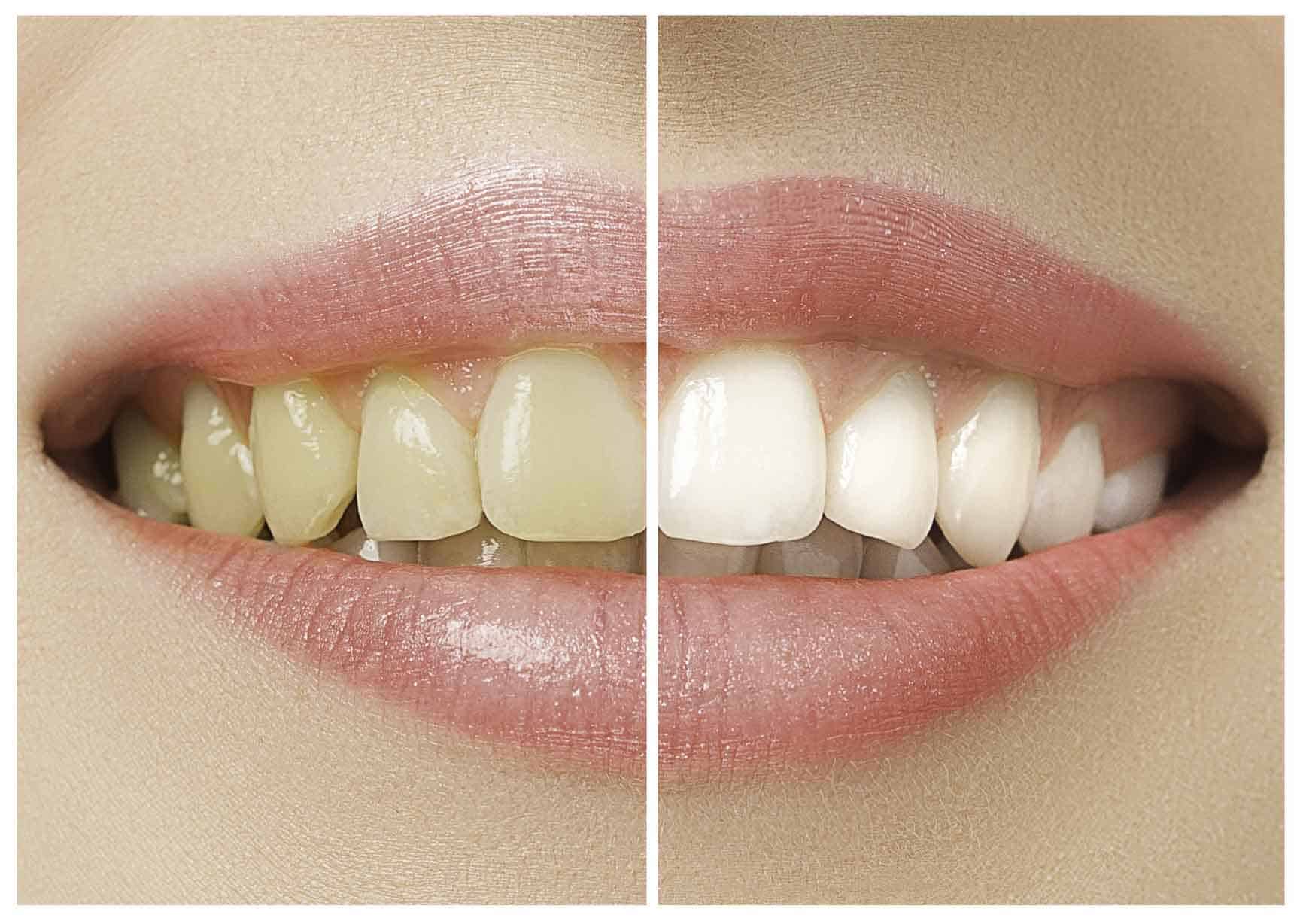 tooth whitening