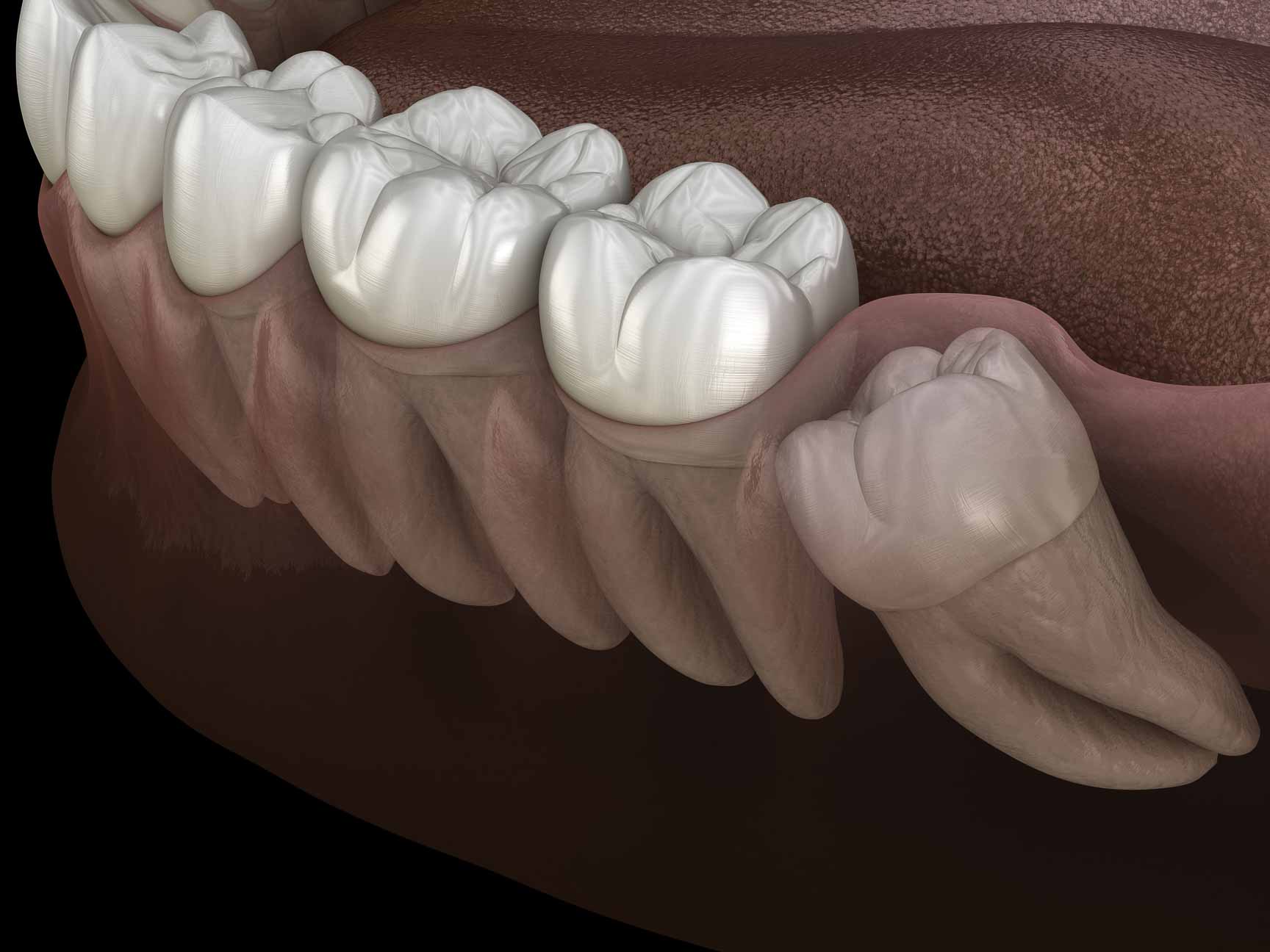 wisdom teeth